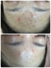 メイユール(MEILLEUR)/光フェイシャル1回