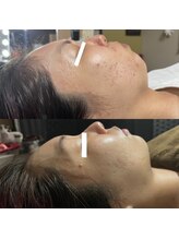 ワイサロン(Y salon)/陶肌トリートメント/4回目