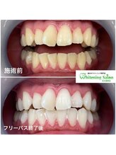 ホワイトニングサロン 名古屋駅店/【ホワイトニング施術例】