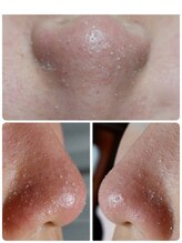 ビアンカーラ(Biancara)/浮き出る【韓国式3D毛穴洗浄】