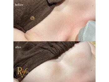 ラヴィス(RAVIS)/光豊胸バストアップ!