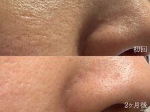 ウォーム(warm)/【肌質改善専門店warm】毛穴洗浄