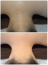 リンク(LINK.)/うなじ光脱毛