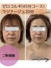 【ラジオ波フェイシャル】小顔リフト★45分/ラジナージュ20分