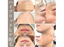 ランプ(LAMP)の雰囲気（LAMPオリジナル【爆抜け!ハイブリッドヒゲ脱毛】大人気です♪）