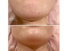 ラヴィン なんばスカイオ店(Lovin)/【ソフトハーブピーリング6回】