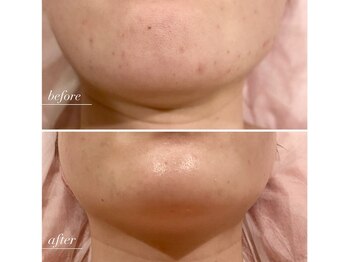 ラヴィン なんばスカイオ店(Lovin)/【ソフトハーブピーリング6回】