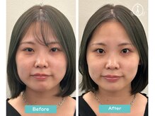 アイ(i)/ビフォーアフター