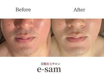 イーサム 高槻摂津富田店(e-sam)/髭脱毛
