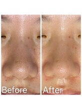 エステ シンセリティー(aesthetic sincerity)/毛穴洗浄9800円→モニター4500円