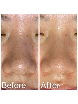 エステ シンセリティー(aesthetic sincerity)/毛穴洗浄9800円→モニター4500円