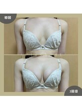 プラス バスト(+Plusバスト)/お客様BeforeAfterお写真