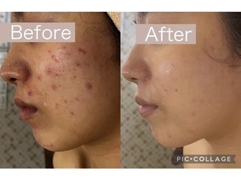 マスカレード 品川(Masquerade)/【症例写真】施術1回