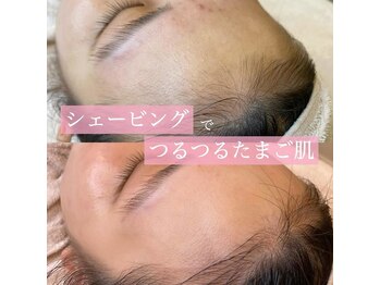 リンド エステ まつげ 京成大久保(Lind)/つるつるたまご肌