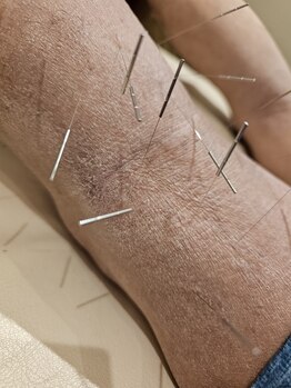 はりきゅう和 ルート鍼灸院/皮ふの状態