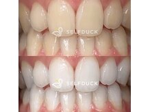 他店で効果を得られなかった方！赤坂で希少ホワイトニングサロン