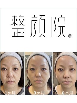 整顔院 池尻大橋店の写真/キュッと引き締まった小顔へ☆たるみリフトアップで、自信あふれる表情に!