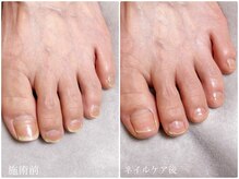 ディグニティ(Dignity)/フットネイルケア/欠けやすい爪