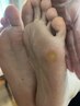 【ガチガチかかと・タコ・魚の目撃退】韓国式フットケア・トラブル