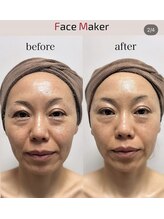 ティアラ 北千住(TIARA)/リフトアップの最新機器
