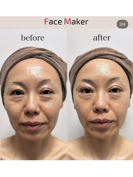 ティアラ 北千住(TIARA)/リフトアップの最新機器