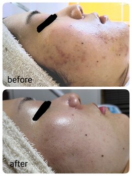 レゾン 京橋店/【ビフォーアフター】ニキビケア