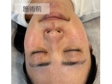 MTサロン 大名店/超音波洗浄の施術例１