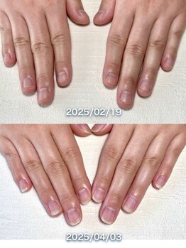 ポメロ(POMELO)/短期集中のケアで爪の形は変わる
