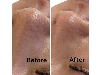 ブライトプラス(BRIGHT+)/ハイドロフェイシャル毛穴洗浄