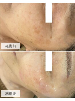 ラシック(La Chic)/シミケア7回