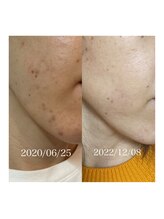 リュウ(le.lieu)/化粧品とエステメニューの併用で