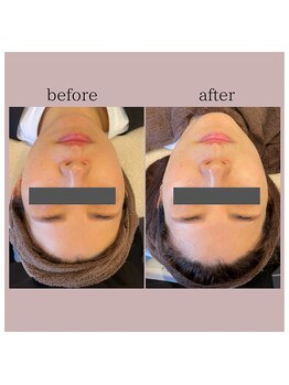 プリエ(BRILLER)/リフトアップ