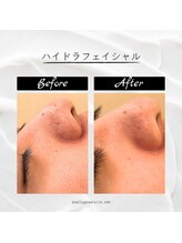 美バリ 新宿店(美BARI)/毛穴汚れ黒ずみに！