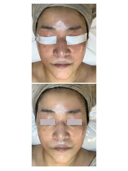 カンパニュラ(campanula)/リアボーテ・幹細胞フェイシャル