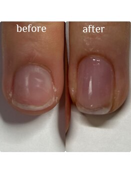 マニュコクーン(ManuCocoon)/爪育成 深爪 巻き爪 大阪市