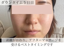 ナナ(nana)/ハーブピーリング｜ダウンタイム