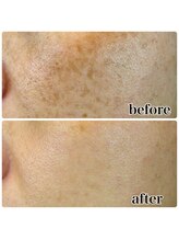 ヴォーグ(Vogue)/パワーライトフェイシャル