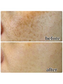 ヴォーグ(Vogue)/パワーライトフェイシャル