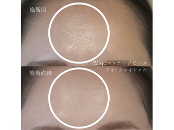 フォトビズ/水光艶肌ワイコマッサージピール