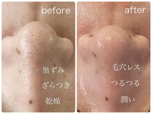 ルミエール フォレストサイド(L’MIERE forestside)の雰囲気（てごわい黒ずみ毛穴に◎角栓を溶かす特殊な毛穴施術できれい持続）