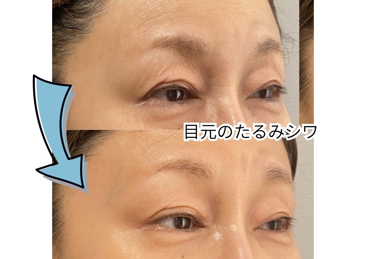 セレブリボーン 大阪ボーテの雰囲気(《ステップ2》ハリ細胞育成~ヒト幹細胞、EXOソーム導入~)