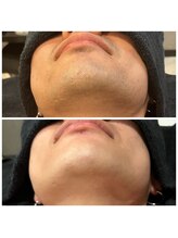 エニー(Any)/ひげ脱毛