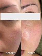 サロンドジェシカ(salon de Jessica)/プラズマ　頬の毛穴