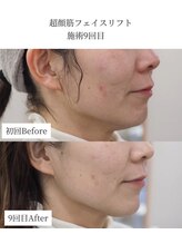 エービューティーサロン 松山店(A BEAUTY SALON.)/40代女性 フェイスラインケア