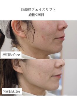 エービューティーサロン 松山店(A BEAUTY SALON.)/40代女性 フェイスラインケア