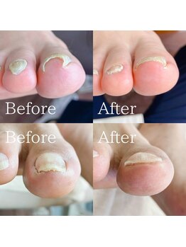 あしから/巻き爪の処置