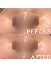 アマリリス(Amaryllis)/毛穴洗浄before/after