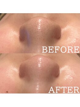 アマリリス(Amaryllis)/毛穴洗浄before/after