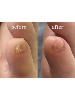 角質ケアができるサロン