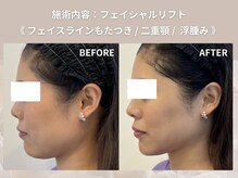 エヌズ(Ns)/切らない糸リフト